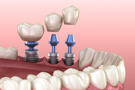 crowns placement over implants