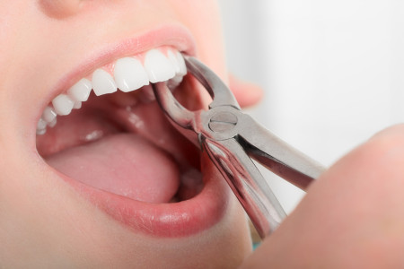 dentist removing wisdom teeth