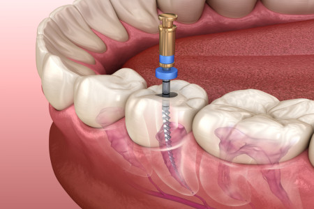 quality 247 endodontic root canal treatment