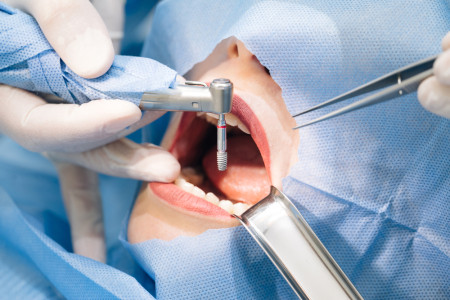 installing dental implants